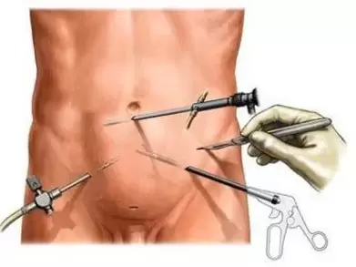 tratamento cirúrxico da prostatite crónica