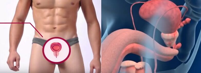 Prostatite nos homes, recoñecible por certos signos