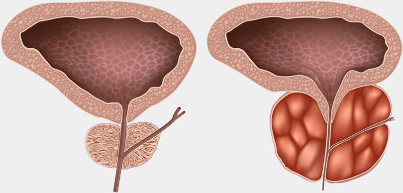 próstata sa e inflamada con prostatite