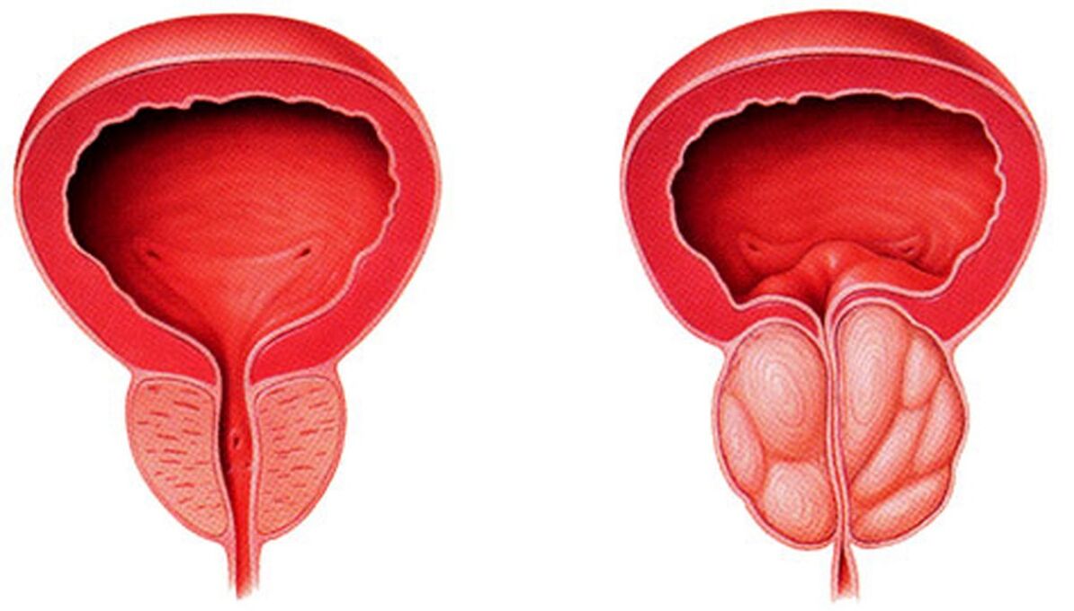 próstata sa e inflamada con prostatite