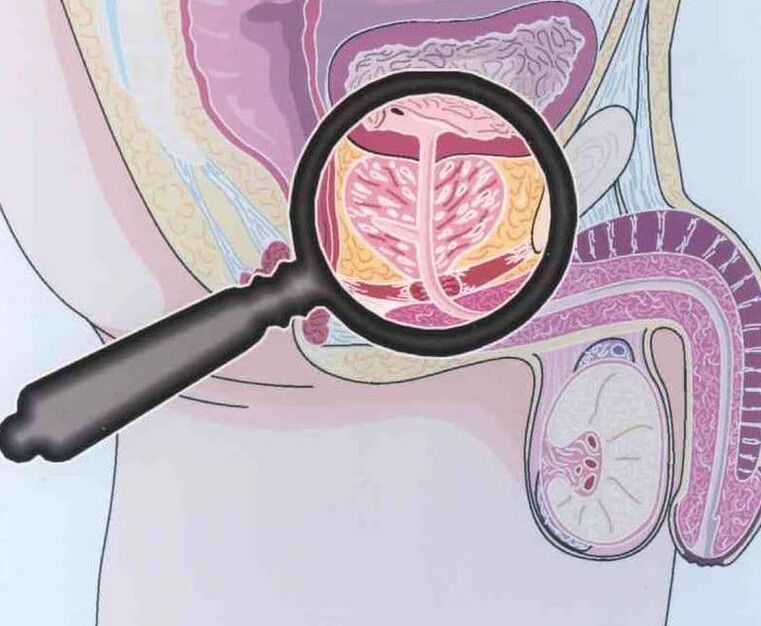 Implicación do tecido prostático en homes con prostatite crónica